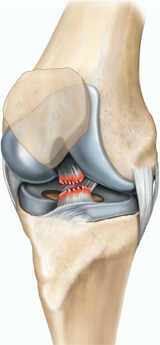 ACL Reconstruction