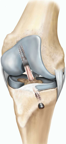 ACL Reconstruction