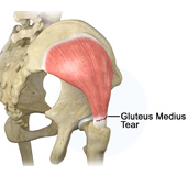 Gluteus Medius Tear