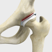 Hip Labral Tear