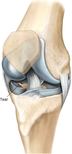 knee-arthroscopy