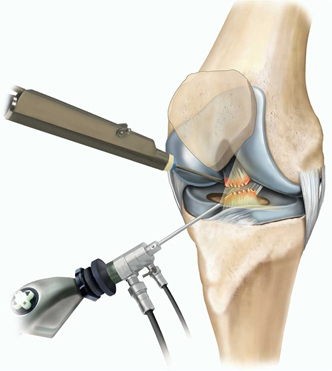 knee-arthroscopy