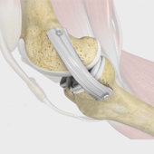 MCL Reconstruction