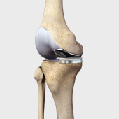 MPFL Reconstruction