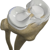 Meniscal Repair