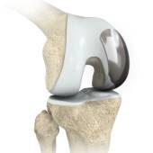 Unicondylar Knee Replacement