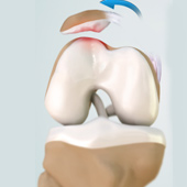 Patellar Dislocation / Patellofemoral Dislocation