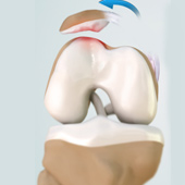 Patellofemoral Dislocation