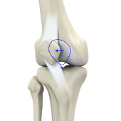 Patellar Instability Management