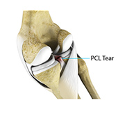 PCL Injuries