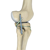 Posterolateral Corner Reconstruction