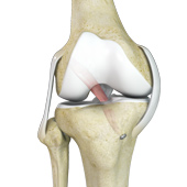 Revision ACL