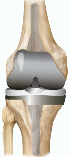 A revision total knee replacement