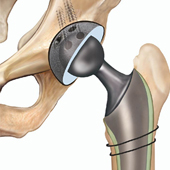 Revision Total Hip Replacement