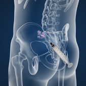 Sacroiliac Injections