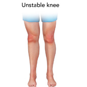 Unstable Knee