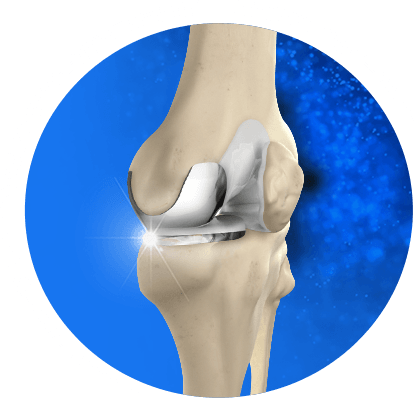 Knee Arthroscopy